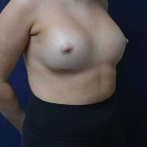After-2-10-22-25-YO-F-Breast-Augmenation-Silicone-and-Lipo-suction-to-the-axilla-2-821x1024