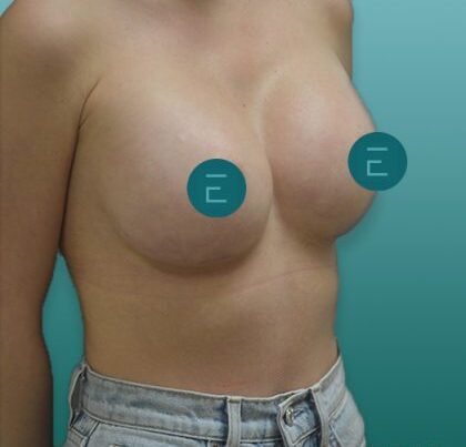 breast2-1-420x487