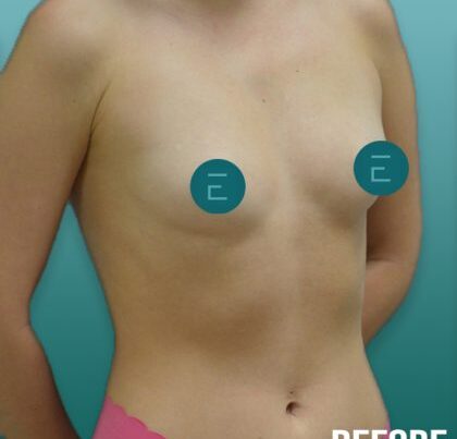 breast2-copy-1-420x463