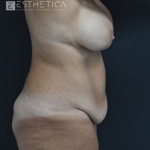 Liposuction-of-the-abdomen-1-before